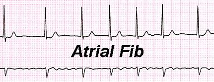atrial fibrillation image