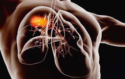 microwave ablation lung cancer image